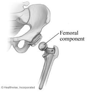 The hip joint Ball and socket joint Head of femur (ball) Pelvis (socket) Joint held together with ligaments which allow movement and stability