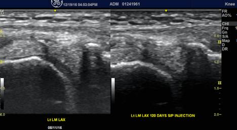 Lateral meniscus homogeneity is well displayed below in the post