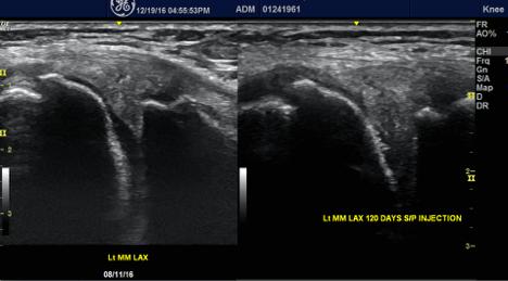 Below is a before and after image of the medial meniscus image which