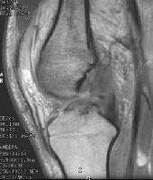 Primary signs of the ACL tear Disruption,