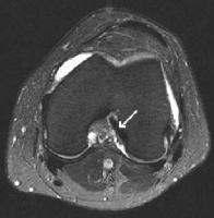 MRI KNEE - WHAT TO SEE MRI is the most accurate and frequently used diagnostic tool for evaluation of internal