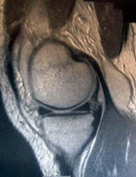 Meniscus Normal anatomy The normal meniscus shows uniform, low signal intensity (Black)