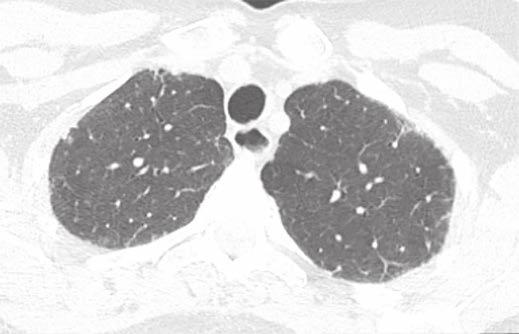 usual interstitial pneumonitis pattern of pulmonary fibrosis. reflux also appears to be associated with pulmonary fibrosis and is associated with worse survival [11, 12]. A Fig.