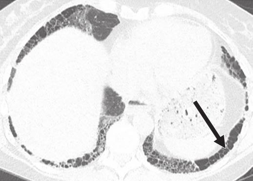 Axial CT image shows mild ground-glass opacity superimposed on reticulation and traction bronchiolectasis in posterior costophrenic angles (possible usual interstitial pneumonitis