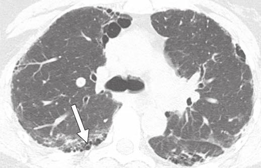 CT Diagnosis of Idiopathic Pulmonary Fibrosis Usual interstitial pneumonitis (UIP) is the imaging and histologic correlate for IPF.