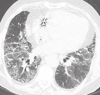 Multidisciplinary Approach to UIP and IPF Diagnosis Fig. 3 79-year-old man with acute shortness of breath in setting of idiopathic pulmonary fibrosis.