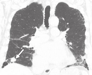 Axial CT image shows mild fibrosis (reticulation and mild traction bronchiectasis, as well as bronchiolectasis) most concentrated in peribronchovascular region with relative subpleural sparing