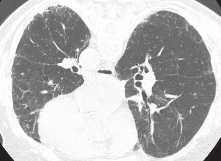 4 81-year-old man with known pulmonary fibrosis. Coronal CT image shows basilar and peripheral pulmonary fibrosis with honeycombing in usual interstitial pneumonitis pattern.