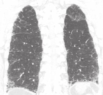 A and B, Axial (A) and coronal (B) CT images show basilar and peripheral pulmonary fibrosis without honeycombing; these findings indicate possible usual interstitial pneumonitis pattern.