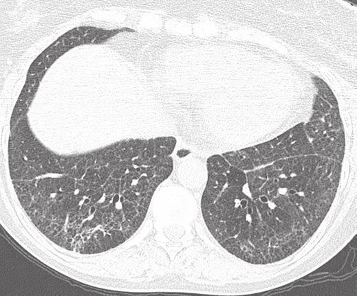 In patients with UIP, mild ground-glass opacity typically represents pulmonary fibrosis beyond the resolution of chest CT, especially if it occurs in areas of obvious fibrosis (Fig. 2).