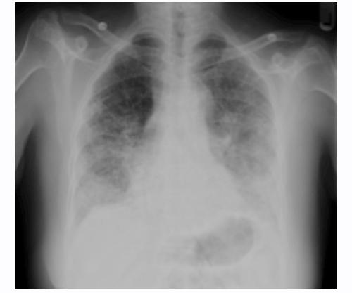 Table 2. Pulmonary Function Test Results -End Table- Radiology The chest x-ray demonstrates the characteristic plain film findings of interstitial lung disease (Figure 1).