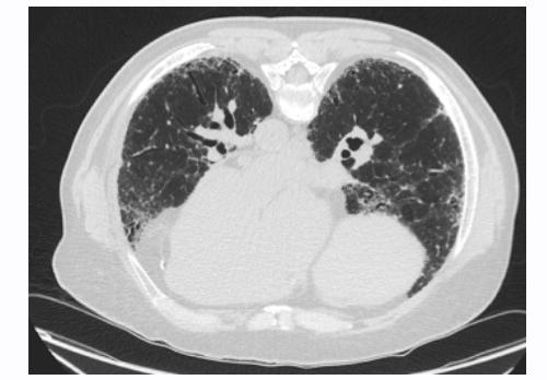Figure 2. Supine CT Findings Prone CT images are beneficial for evaluating interstitial lung disease and differentiating it from dependent changes found on supine images (Figure 3).