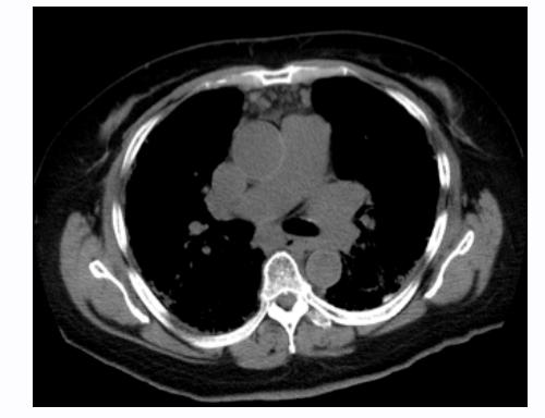 Prone CT Findings In addition, there are prominent mediastinal lymph nodes, which often accompany interstitial lung disease (Figure 4). -Figure 4- Figure 4.
