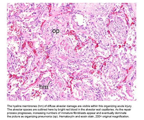 An autopsy is performed and lung pathology shows acute injury superimposed on background fibrous remodeling of UIP, consistent with AEIPF (Figures 10 and 11). -Figure 10- Figure 10.