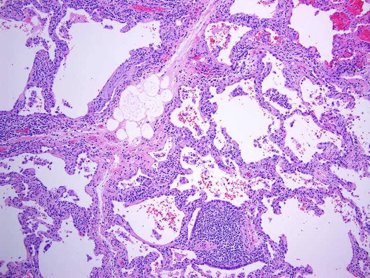 Case 3 -Diagnosis Cellular nonspecific interstitial pneumonia with prominent lymphoid aggregates and organizing pneumonia I would probably be thinking connective tissue disease, but it looked like a