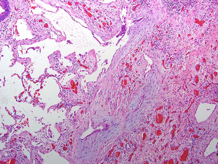 Patchy involvement of lung Fibroblast foci