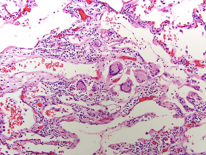 Fibrosis Pathologic