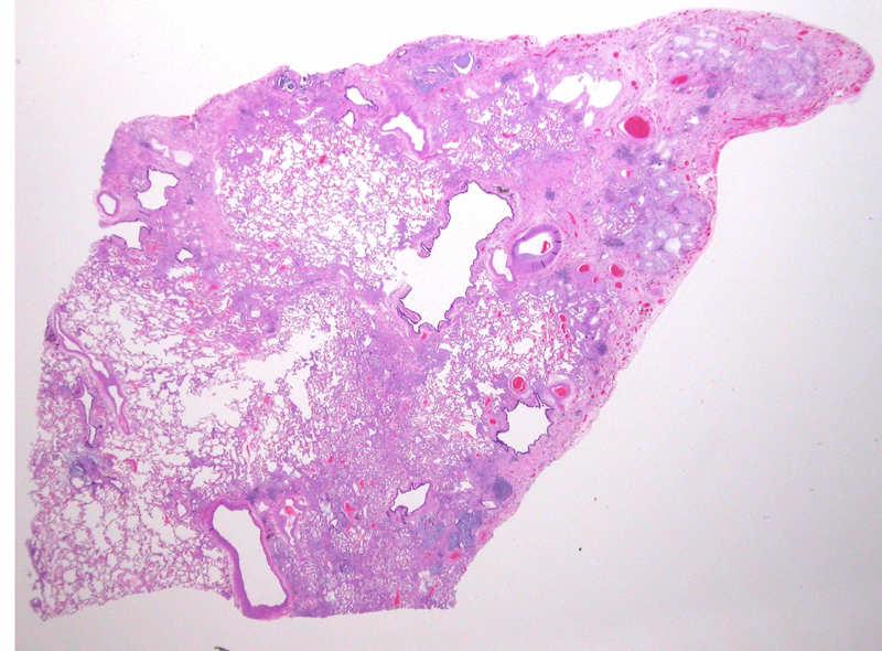 Diagnosis of UIP Make your pathologist aware of clinical