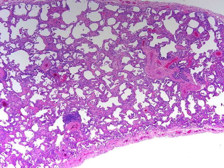alveolar septal thickening by inflammation and/or fibrosis