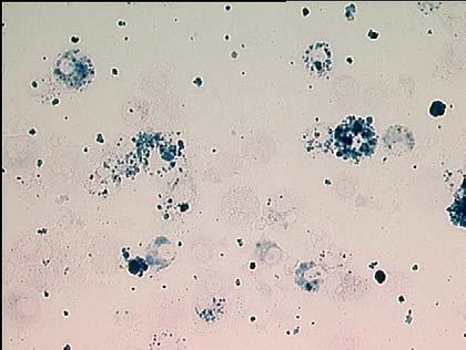Figure 2 Bronchoalveolar lavage fluid stained for hemosiderin showing