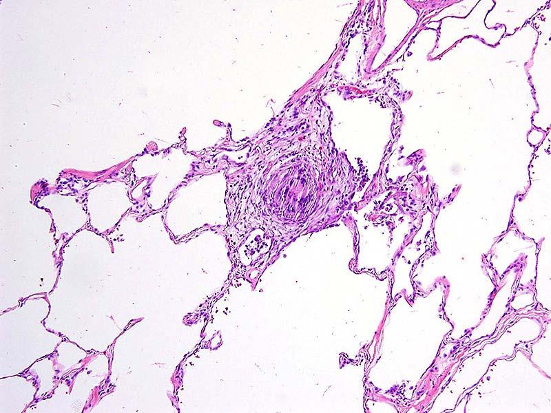 Case 1 Diagnosis Interstitial fibrosis, usual interstitial pneumonia pattern, with increased peribronchiolar fibrosis (basilar).