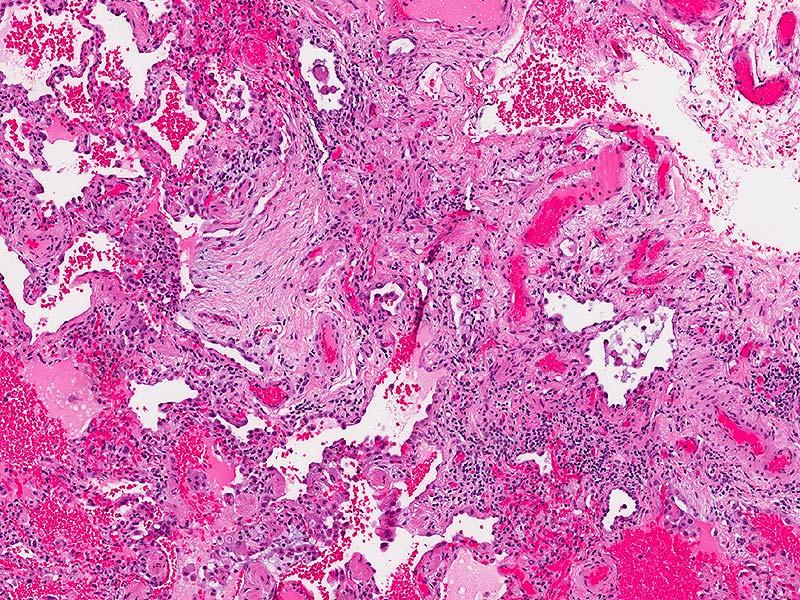 Case 3 Diagnosis Cellular and fibrosing nonspecific interstitial pneumonia with focal bronchiolocentric fibrosis and organizing