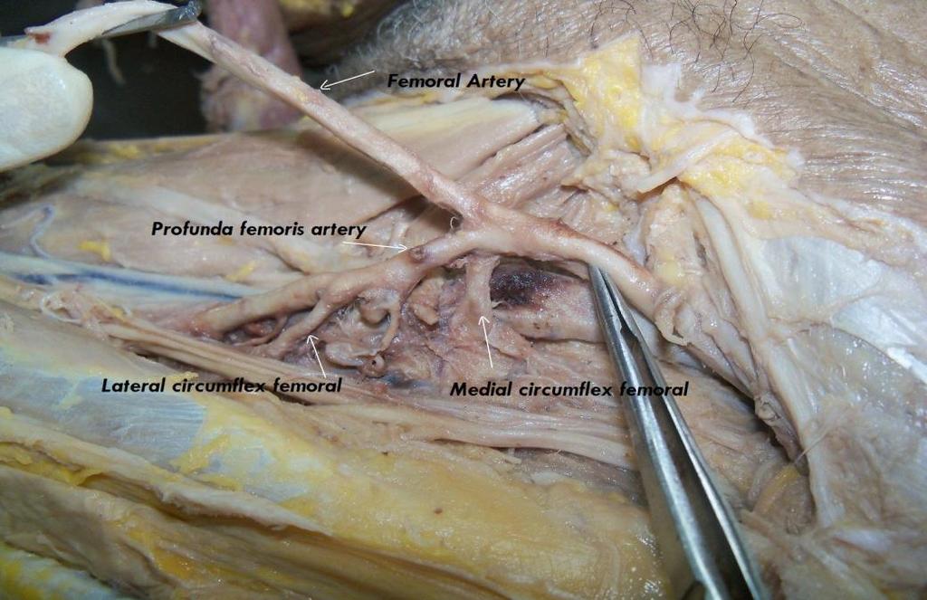 Figure 1: Showing the femoral artery shows the common stem