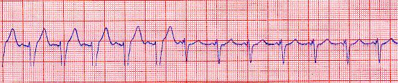 Biventricular Pacing Reduces QRS Duration -------Therapy