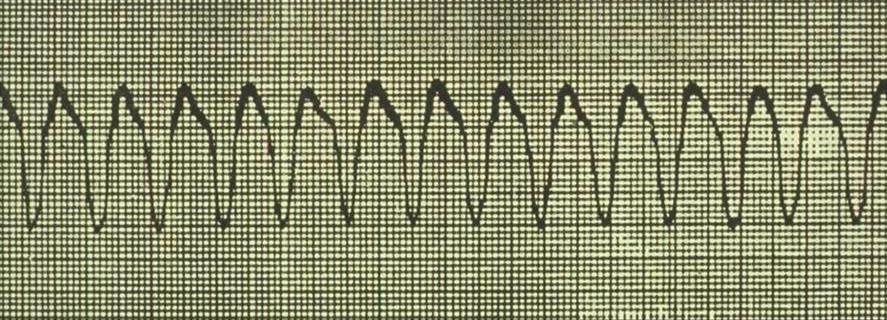 Fast rhythms that require cardioversion