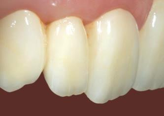 CAD/CAM manufactured frameworks of high-strength zirconium oxide Individually coloured frameworks in eight shades Dentin-like, natural translucency Aesthetically tapered edges, even supragingival