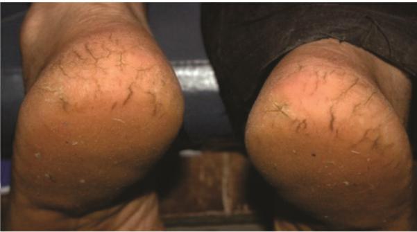 Heels of the patients before and after the