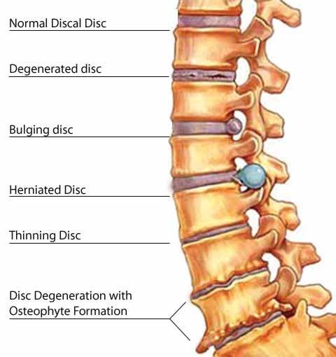 Degeneration of inter vertebral disc causes many ailments in the spine.