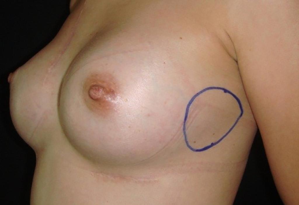 Aggressive fibromatosis (desmoid tumor) associated with breast implant Cases report Case 1 Female, born on 09/04/1980.