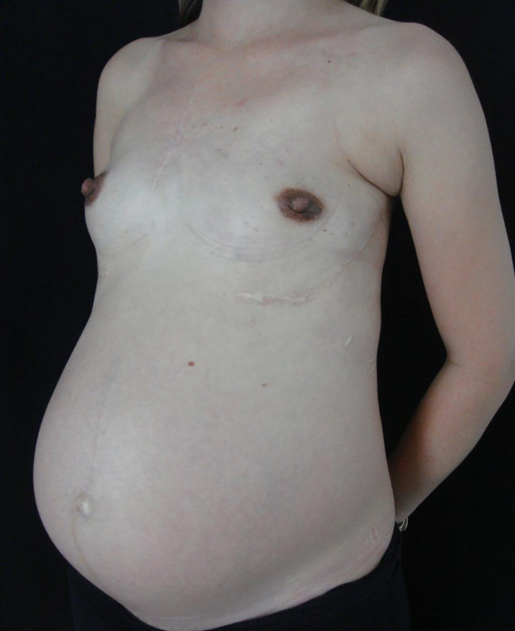 Aggressive fibromatosis (desmoid tumor) associated with breast implant Figure 10. Pregnant patient, cured from aggressive fibromatosis. Figure 11.
