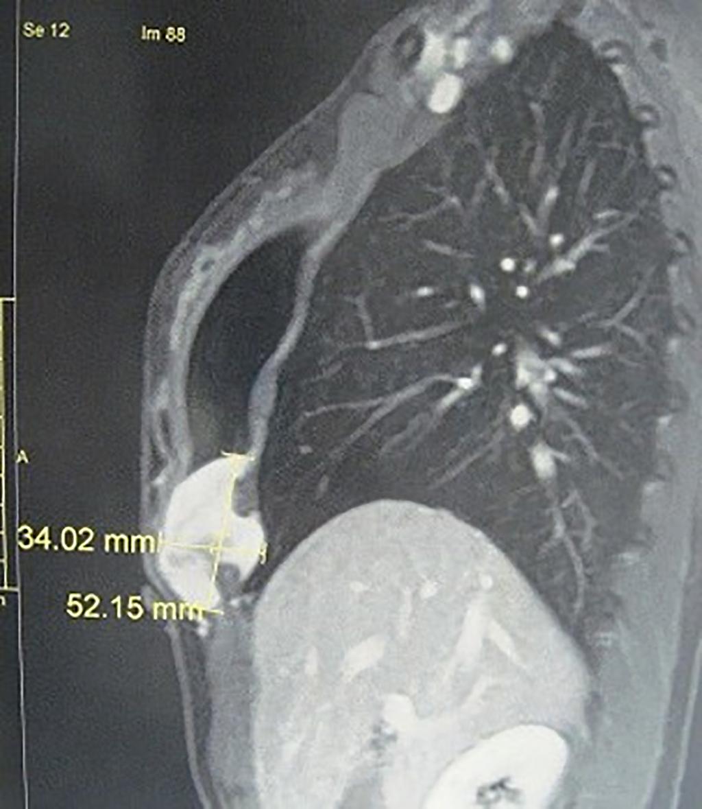 Case 3 Female, 38 years presented at the Hospital Júlia Kubitschek in Belo Horizonte, Minas Gerais, Brazil, on 08/18/2015, with a tumor in the right thoracic wall, measuring 9.3 x 4.8 x 4.