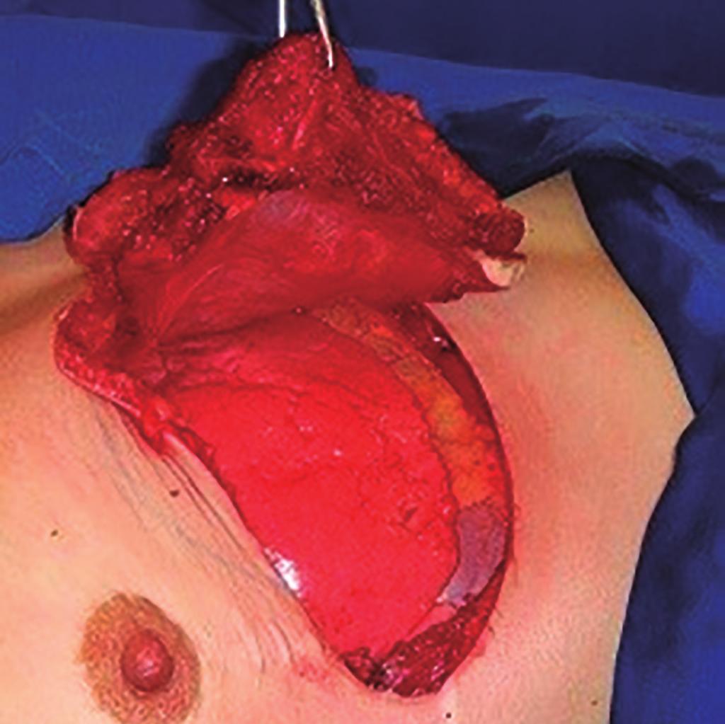 Silva Filho AF et al. www.rbcp.org.br Figure 15. Postoperative aspect. Figure 13. Enlarged thoracectomy. Figure 16. Computed tomography showing aggressive fibromatosis displacing right breast implant.