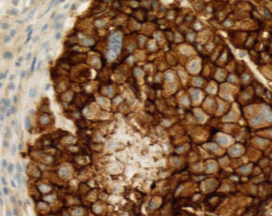 FPA144 Patient Selection with a Proprietary Diagnostic Antibody Can Distinguish FGFR2b from FGFR2c IHC High Staining With Proprietary Diagnostic Antibody (FPR2-D) IHC High is defined as 3+ membrane
