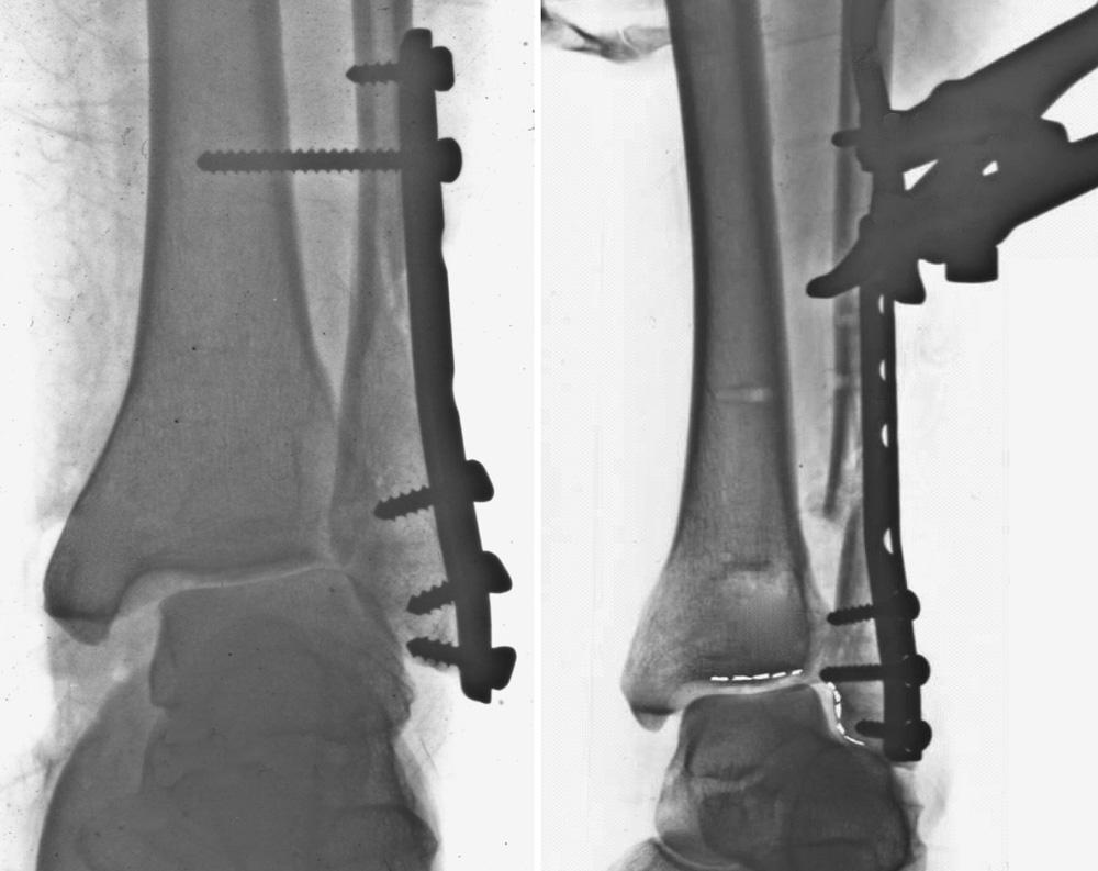 TREATMENT OF MALUNITED FRACTURES OF THE ANKLE 67 Fig. 2a Fig. 2b Fig. 1a Fig.