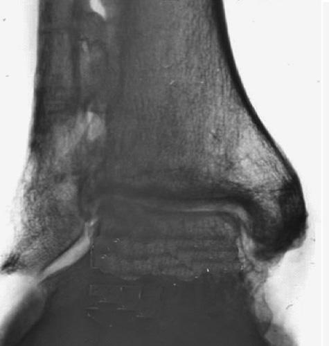 The ankle was then immobilised for six weeks in a below-knee walking cast, with full weight-bearing if the reconstruction was stable without a positioning screw.