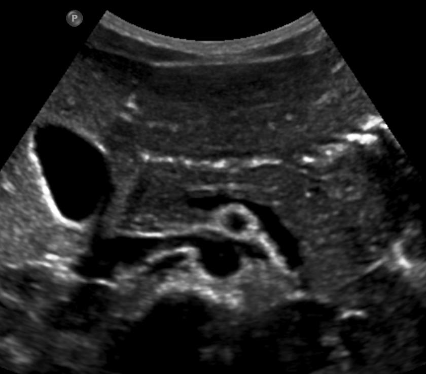 Pancreas Ultrasound Size