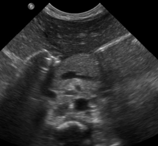 J Ultrasound Med 2000; 19:757-763 Pediatr Radiol