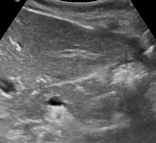 Echogenicity > liver Newborn hyperechoic Preterm