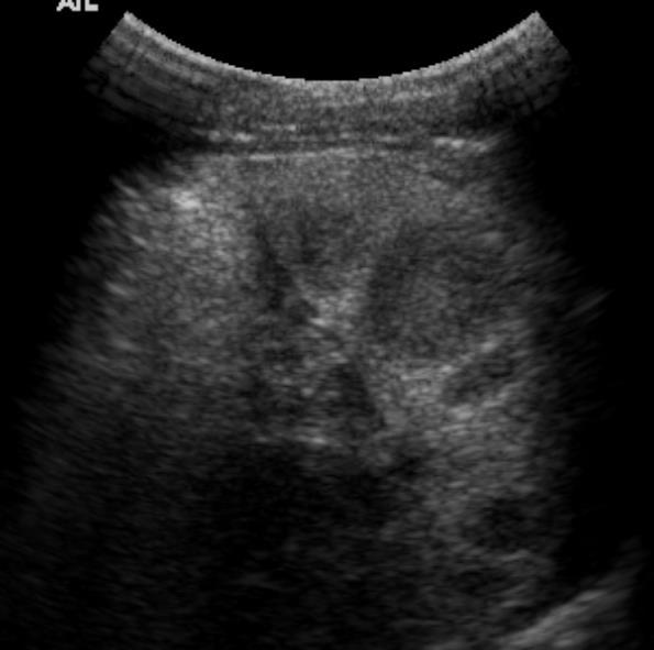 8 yo boy Hb SS and abdominal pain Number: