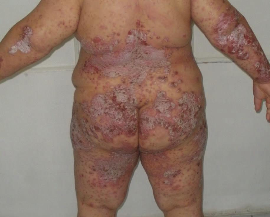 Fig. 1. Pacientã cu psoriazis vulgar sever ºi sindrom metabolic Fig. 1. Patient with severe vulgar psoriasis and metabolic syndrome Tabel 1.