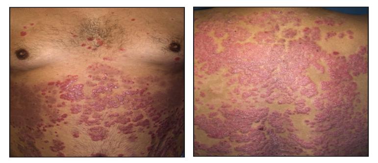 Psoriasis vulgaris An autoimmune skin disease associated with