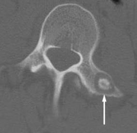 Benign Tumor-Osteoid
