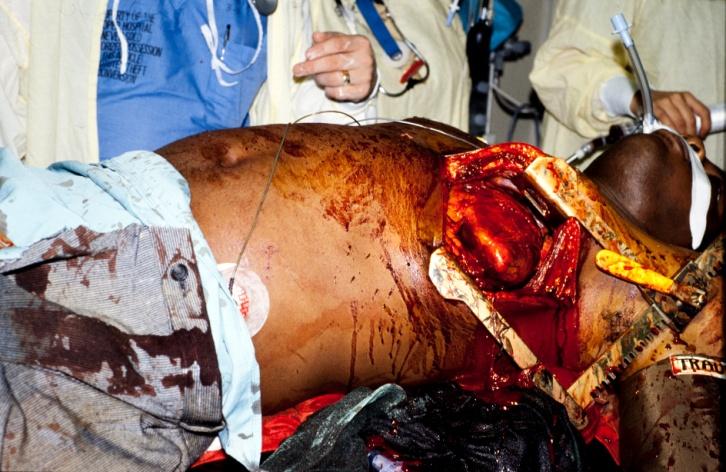 ED Thoracotomy Of very limited utility in blunt trauma Unless signs of life are present at least shortly before admission to ED unlikely to be successful even