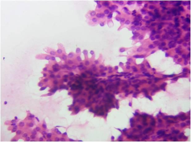 (Figure - 3a, 3b, 3c, 3d) The cells showed mild to moderate pleomorphic nuclei and moderate amount of eosinophilic cytoplasm. (Figure - 4a, 4b) At places, cells showed hobnailed appearance.