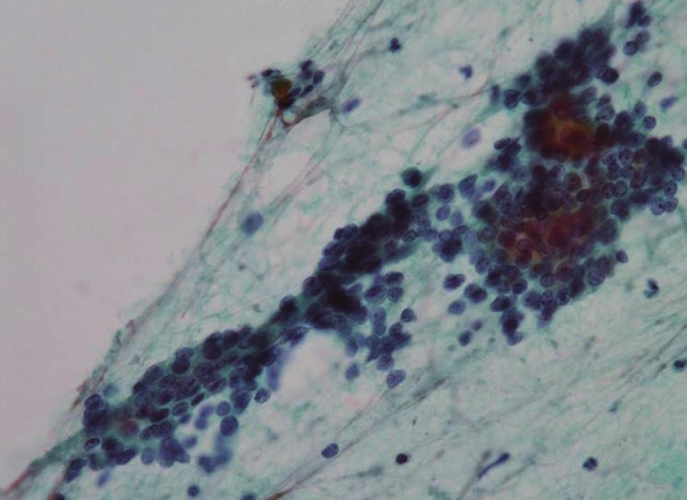 The cytoplasm was scant in most of the tumor cells, and numerous naked cells were identified (Fig. 1C).