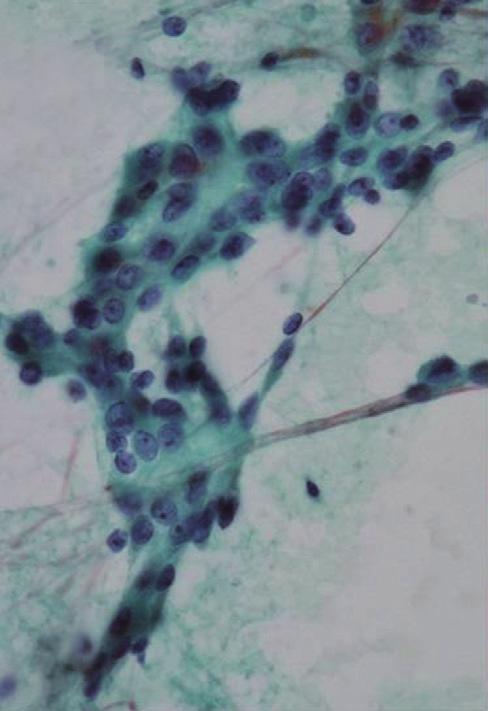 smears. Most psammoma bodies were present in the background and not connected to the tumor cells, but some of them were surrounded by tumor cells (Fig. 1A, inset).